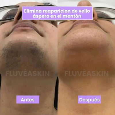 FluvéaSkin® - Vello más fino y menos visible con Raiz de Cyperus Rotundus